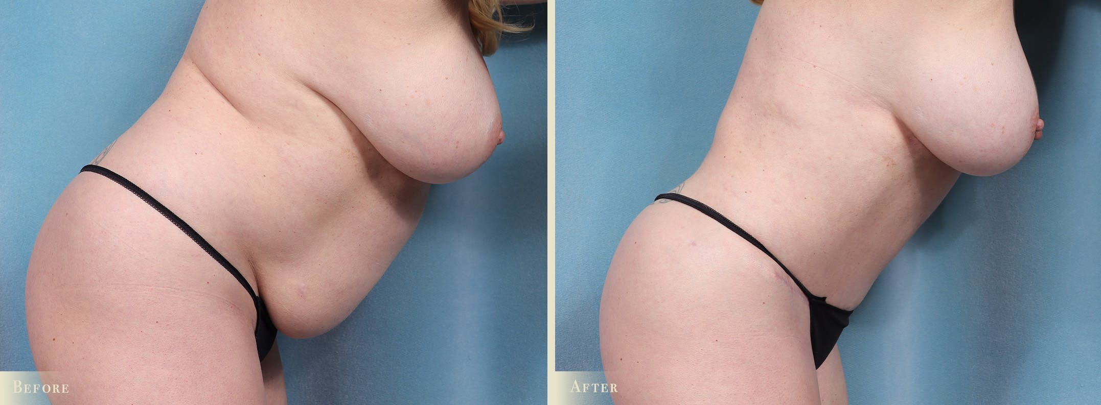 Tummy Tuck Before & After Gallery - Patient 754046 - Image 2