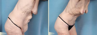 Tummy Tuck Before & After Gallery - Patient 115059 - Image 3