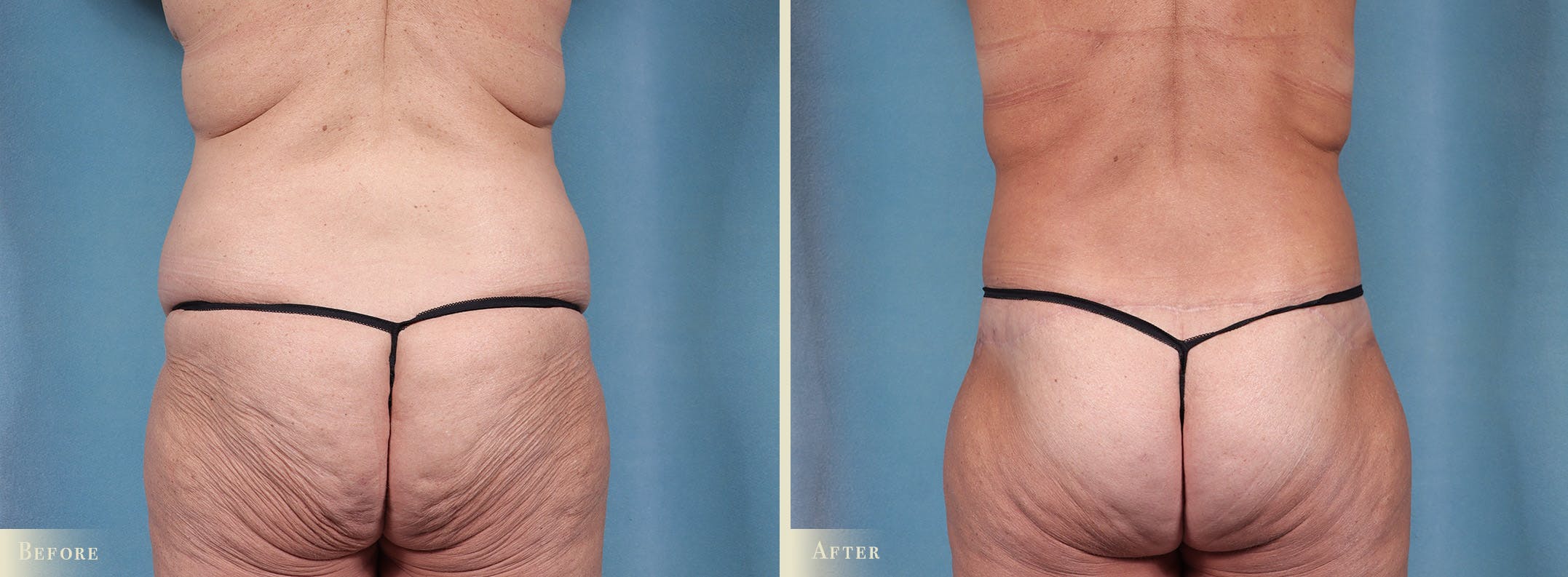Body Lift Before & After Gallery - Patient 106276 - Image 3