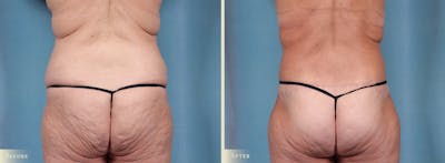 Body Lift Before & After Gallery - Patient 106276 - Image 3