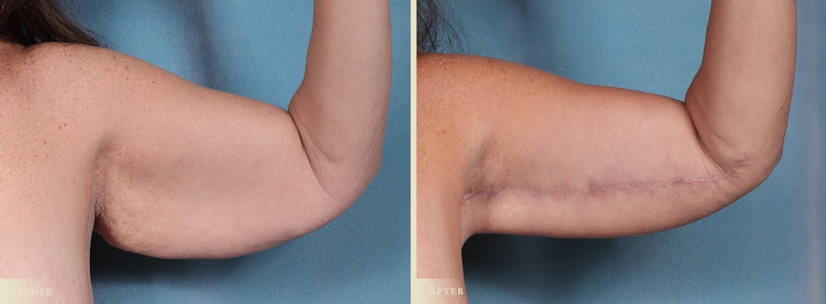 Weight Loss Body Contouring Combination Procedures Before & After Gallery - Patient 300614 - Image 6