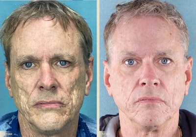 Brow Lift Before & After Gallery - Patient 329197 - Image 1