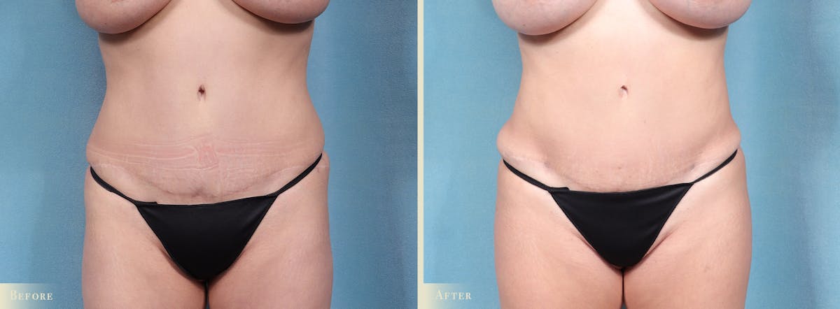 Brazilian Butt Lift Before & After Gallery - Patient 353945 - Image 4