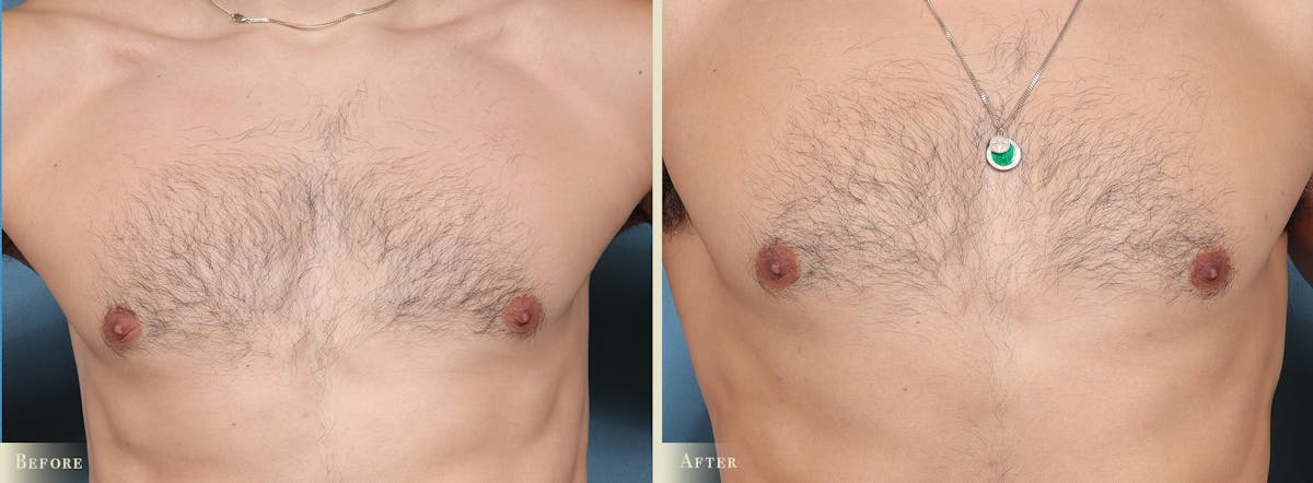 Male Breast Reduction (Gynecomastia) Before & After Gallery - Patient 101135 - Image 1