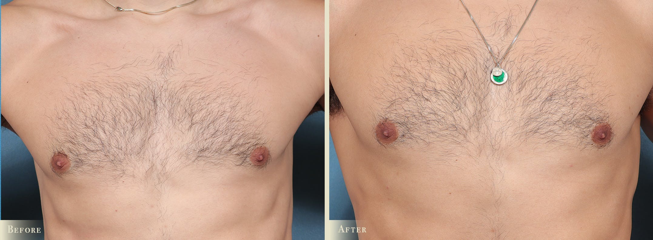 Male Breast Reduction (Gynecomastia) Before & After Gallery - Patient 101135 - Image 1