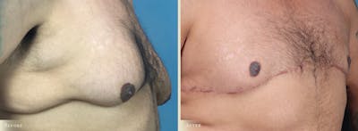 Male Breast Reduction (Gynecomastia) Before & After Gallery - Patient 486411 - Image 2