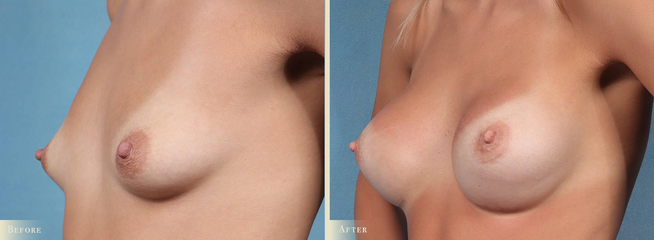 Breast Augmentation Before & After Gallery - Patient 353518 - Image 2