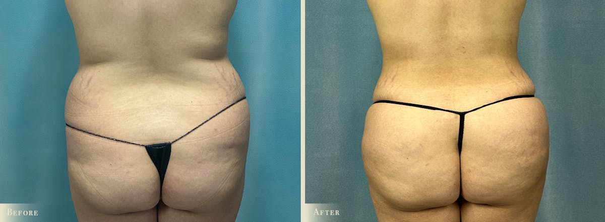 Tummy Tuck Before & After Gallery - Patient 141256 - Image 3