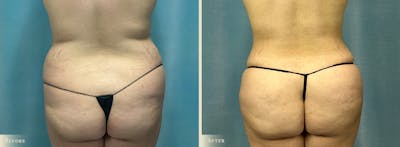 Tummy Tuck Before & After Gallery - Patient 141256 - Image 3