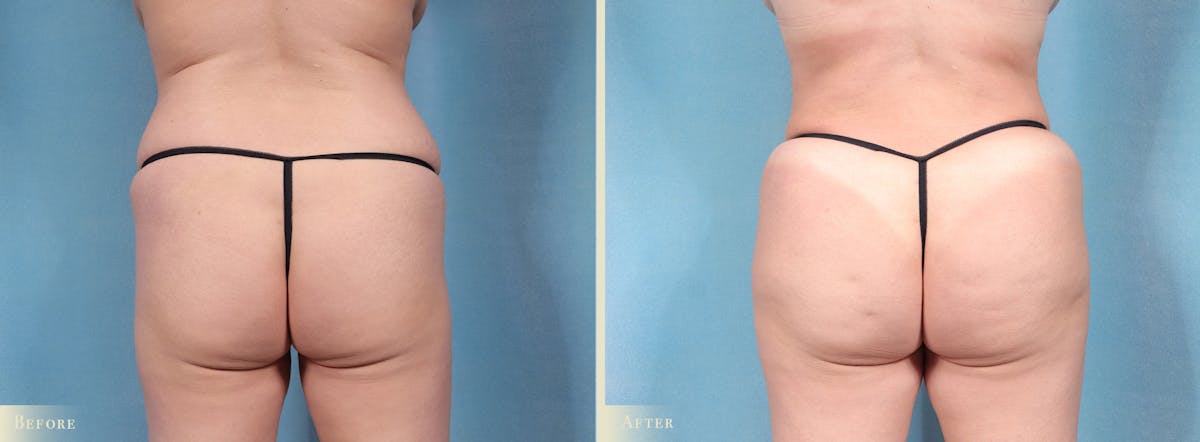 Brazilian Butt Lift Before & After Gallery - Patient 353945 - Image 1