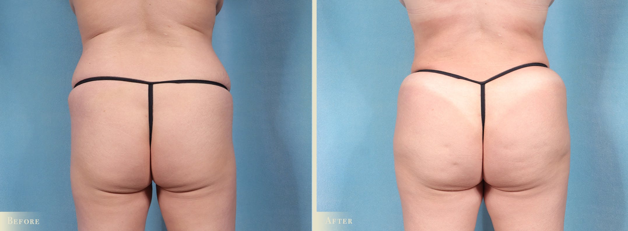 Brazilian Butt Lift Before & After Gallery - Patient 353945 - Image 1