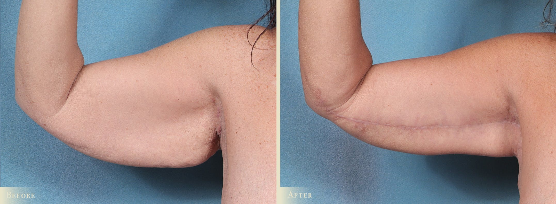 Weight Loss Body Contouring Combination Procedures Before & After Gallery - Patient 300614 - Image 4