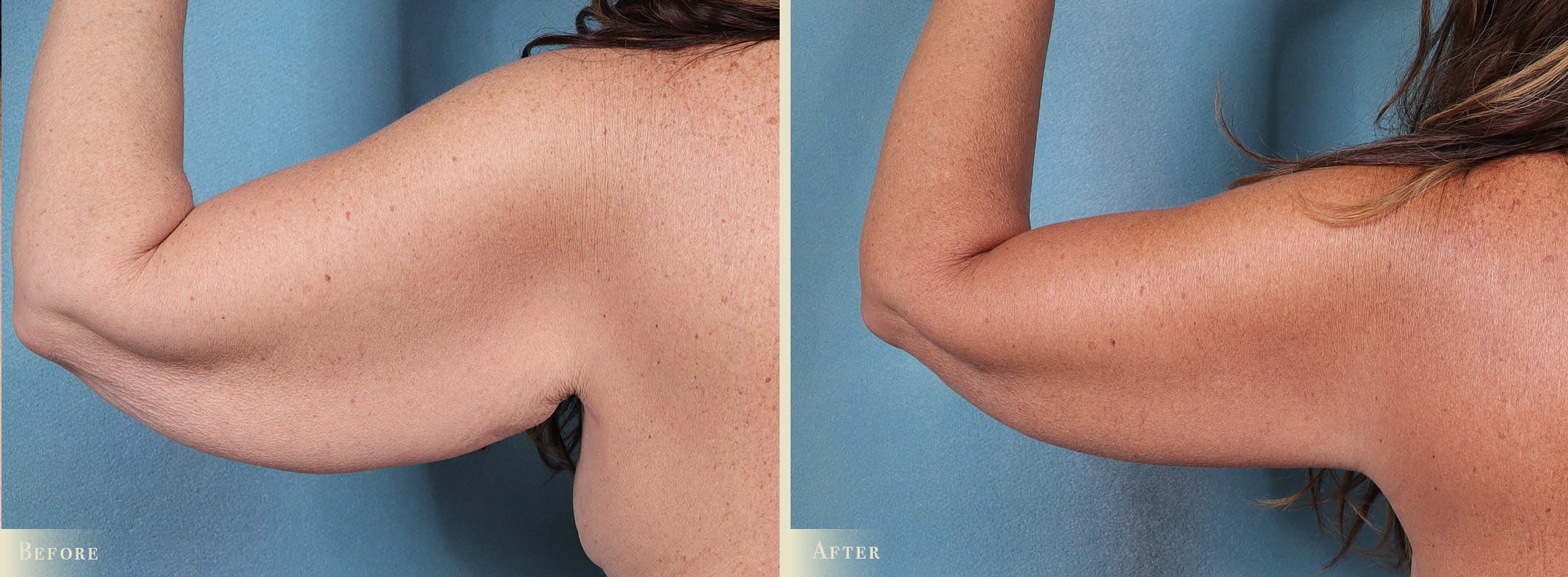 Weight Loss Body Contouring Combination Procedures Before & After Gallery - Patient 300614 - Image 5