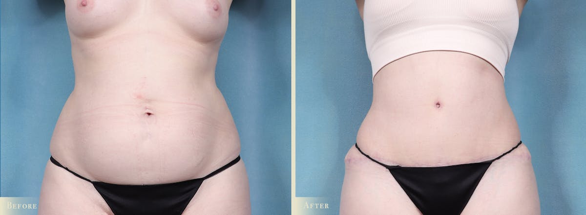 Tummy Tuck Before & After Gallery - Patient 329826 - Image 1