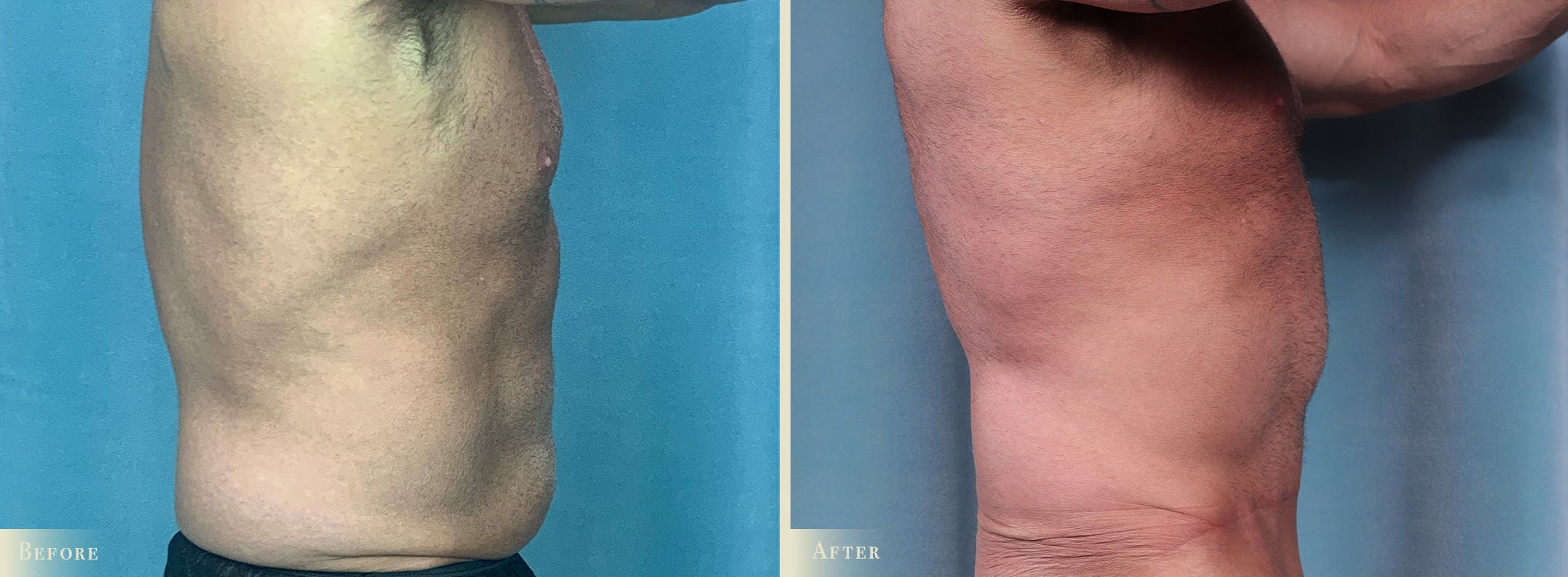 Male Tummy Tuck Before & After Gallery - Patient 383521 - Image 2