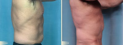 Male Tummy Tuck Before & After Gallery - Patient 383521 - Image 2