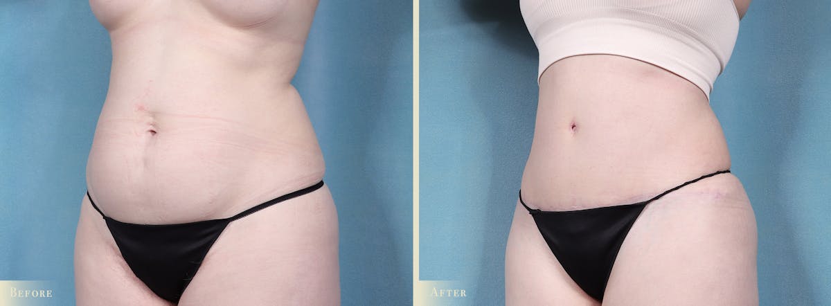 Tummy Tuck Before & After Gallery - Patient 329826 - Image 2