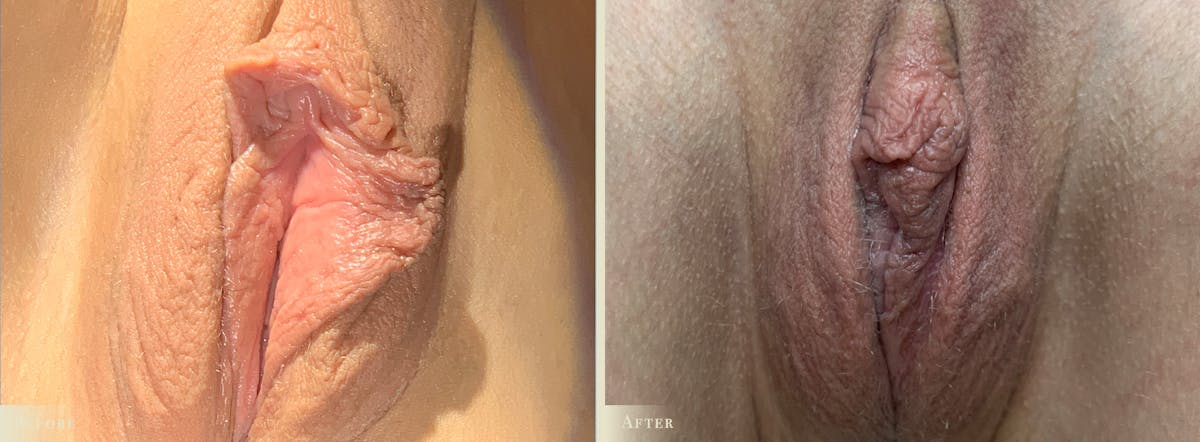 Labiaplasty Before & After Gallery - Patient 323294 - Image 1