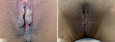 Labiaplasty Before & After Gallery - Patient 229953 - Image 1