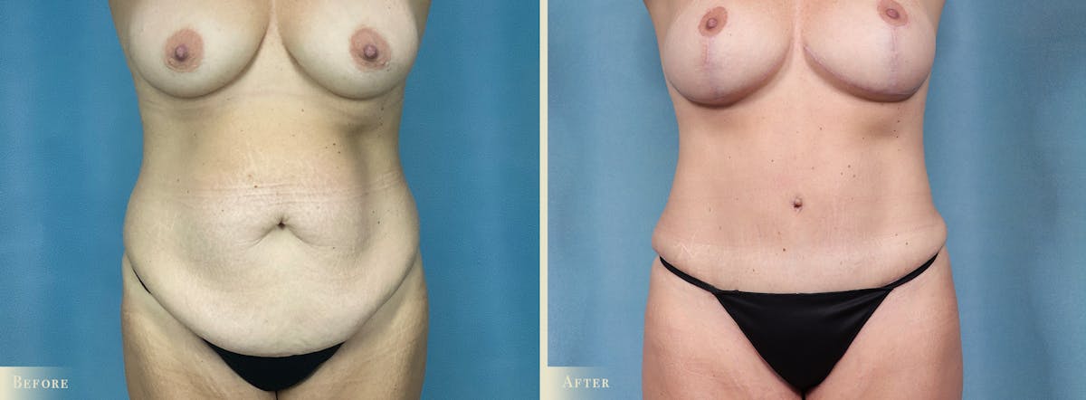 Tummy Tuck Before & After Gallery - Patient 505872 - Image 1