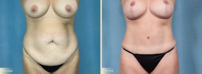 Tummy Tuck Before & After Gallery - Patient 505872 - Image 1