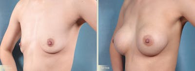 Breast Augmentation Before & After Gallery - Patient 319681 - Image 1