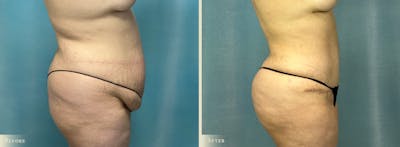 Brazilian Butt Lift Before & After Gallery - Patient 171114 - Image 2