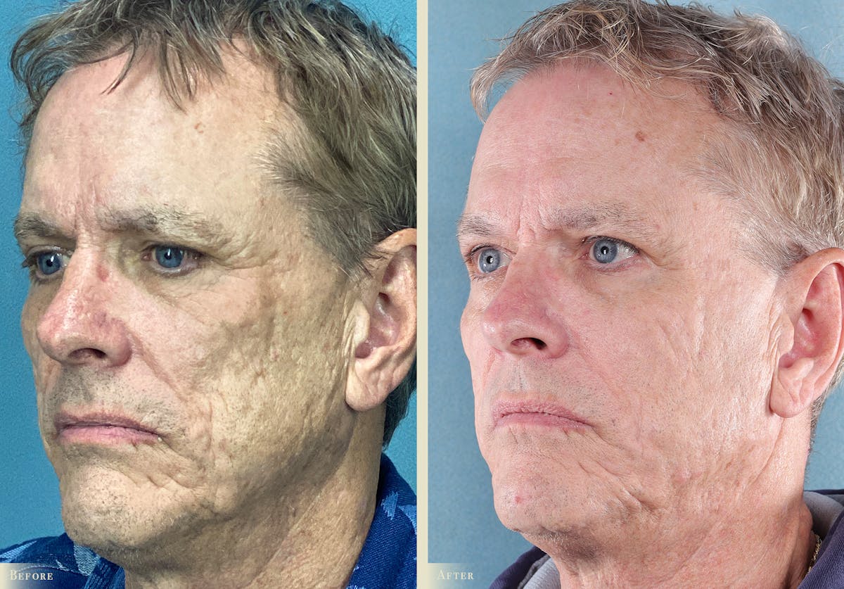 Brow Lift Before & After Gallery - Patient 329197 - Image 2