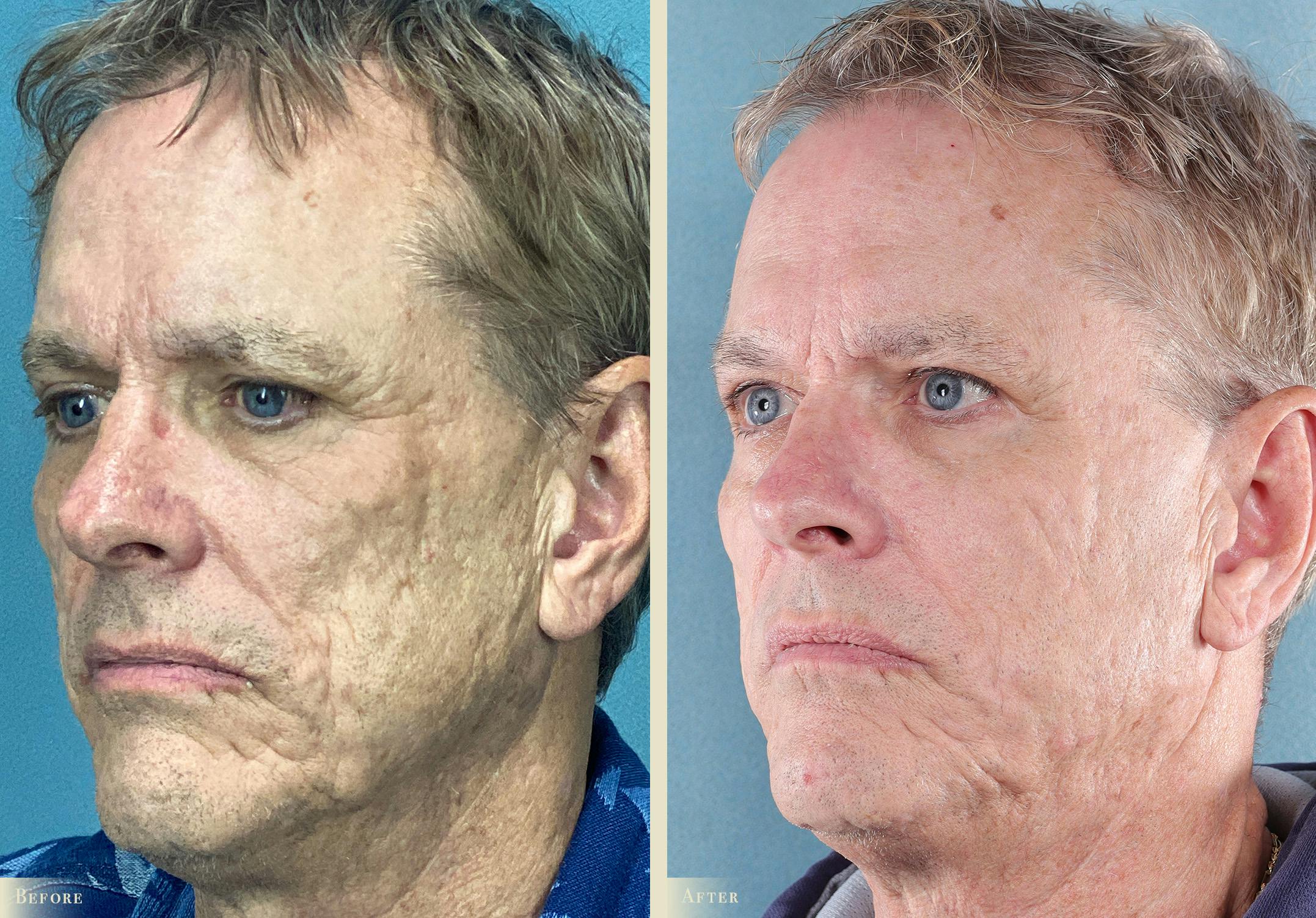 Brow Lift Before & After Gallery - Patient 329197 - Image 2