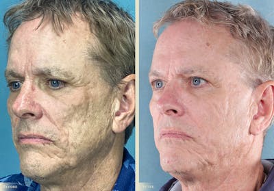 Brow Lift Before & After Gallery - Patient 329197 - Image 2