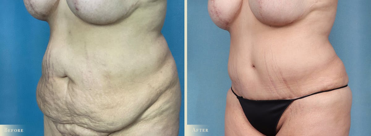 Tummy Tuck Before & After Gallery - Patient 602610 - Image 2