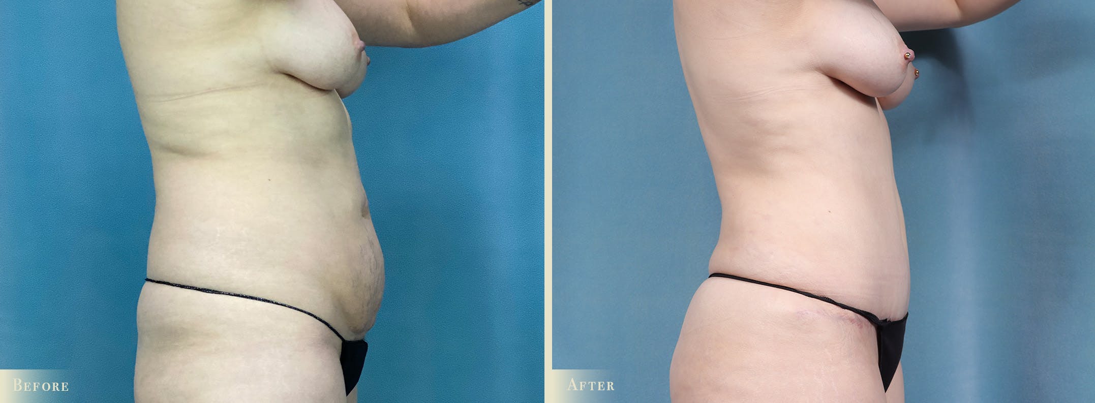 Tummy Tuck Before & After Gallery - Patient 371569 - Image 2