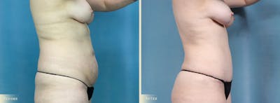 Tummy Tuck Before & After Gallery - Patient 371569 - Image 2