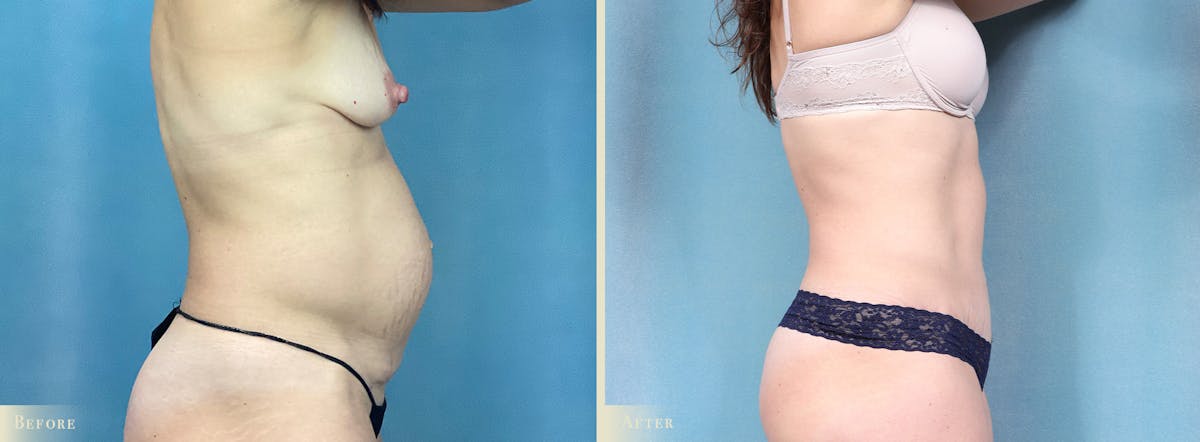 Tummy Tuck Before & After Gallery - Patient 700488 - Image 2
