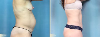 Tummy Tuck Before & After Gallery - Patient 700488 - Image 2