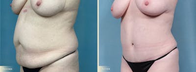 Tummy Tuck Before & After Gallery - Patient 205763 - Image 2