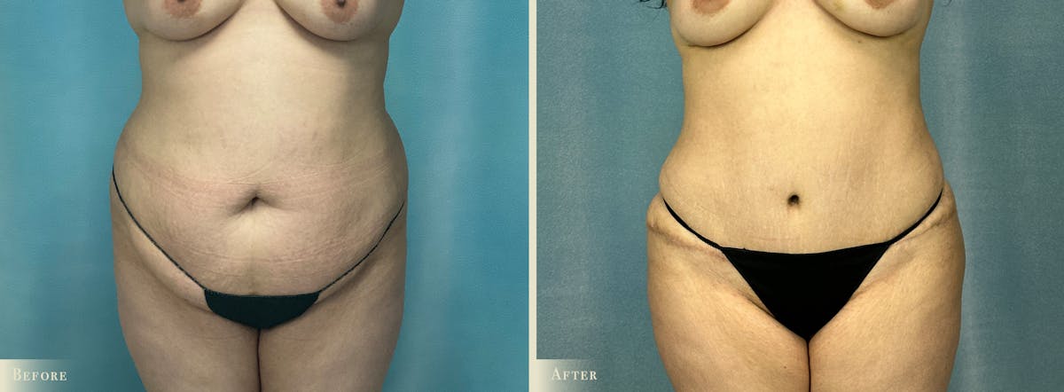 Brazilian Butt Lift Before & After Gallery - Patient 171114 - Image 3