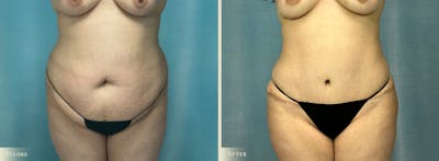 Brazilian Butt Lift Before & After Gallery - Patient 171114 - Image 3