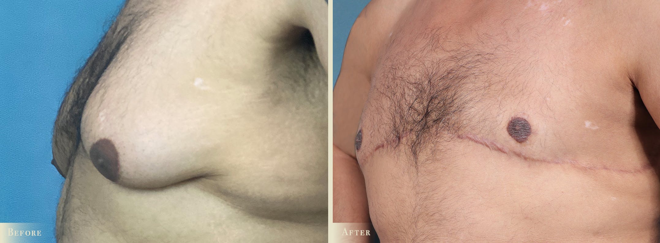 Male Breast Reduction (Gynecomastia) Before & After Gallery - Patient 486411 - Image 3