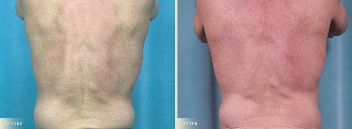 Male Tummy Tuck Before & After Gallery - Patient 383521 - Image 3