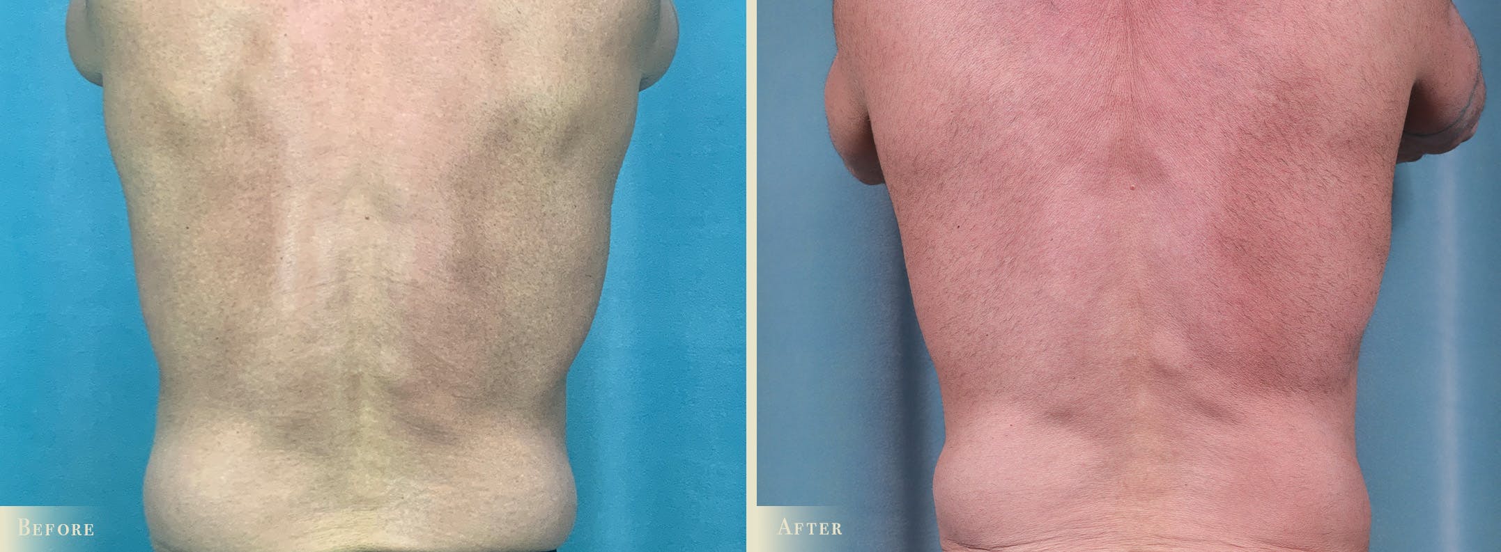 Male Tummy Tuck Before & After Gallery - Patient 383521 - Image 3