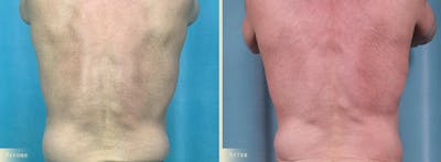 Male Tummy Tuck Before & After Gallery - Patient 383521 - Image 3