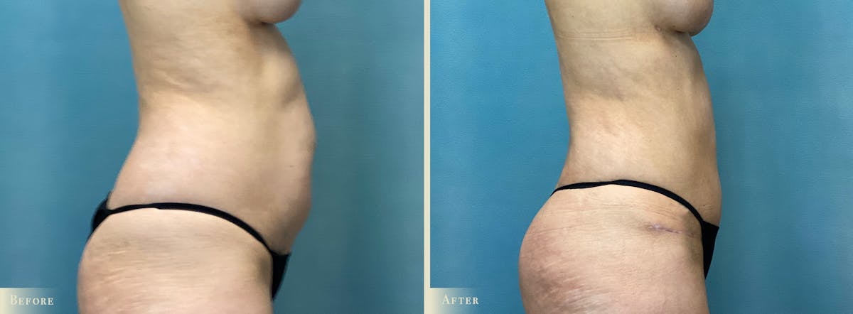 Brazilian Butt Lift Before & After Gallery - Patient 659667 - Image 3