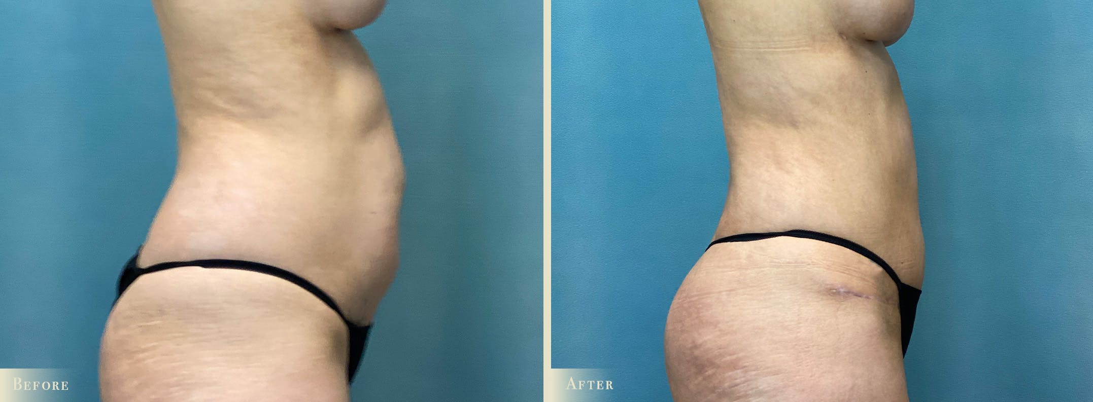 Brazilian Butt Lift Before & After Gallery - Patient 659667 - Image 3