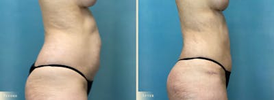 Brazilian Butt Lift Before & After Gallery - Patient 659667 - Image 3