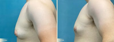 Male Breast Reduction (Gynecomastia) Before & After Gallery - Patient 184612 - Image 3