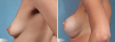 Breast Augmentation Before & After Gallery - Patient 353518 - Image 3