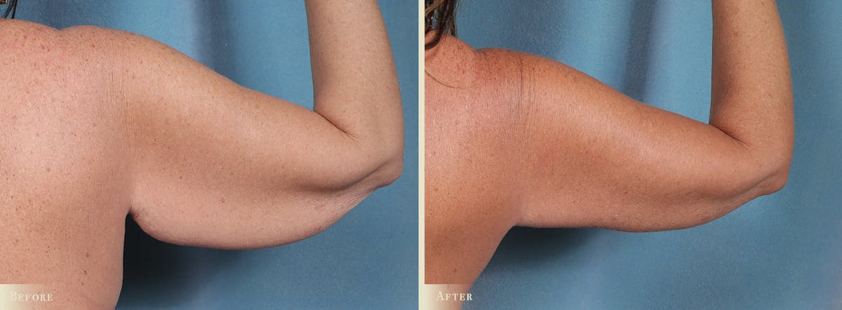 Arm Lift Before & After Gallery - Patient 891604 - Image 3