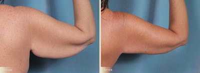 Arm Lift Before & After Gallery - Patient 891604 - Image 3