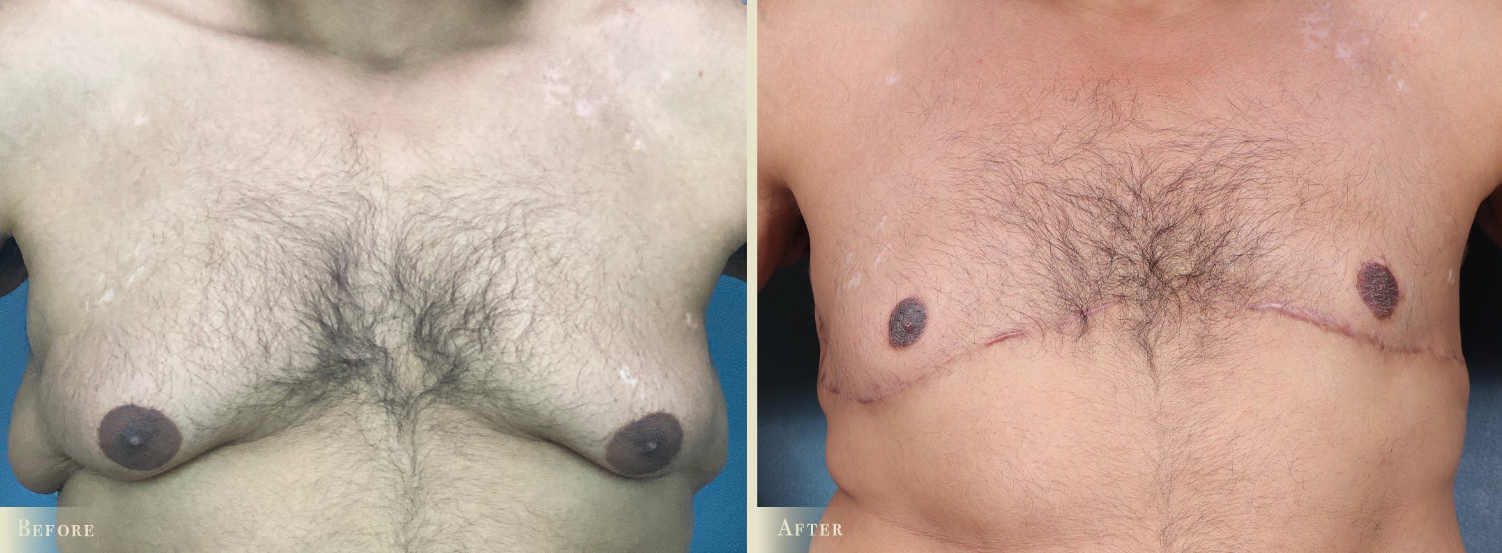 Male Breast Reduction (Gynecomastia) Before & After Gallery - Patient 486411 - Image 1